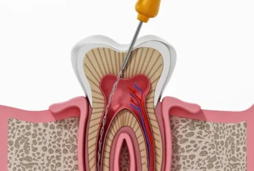 rootcanal treatment in chandanagar