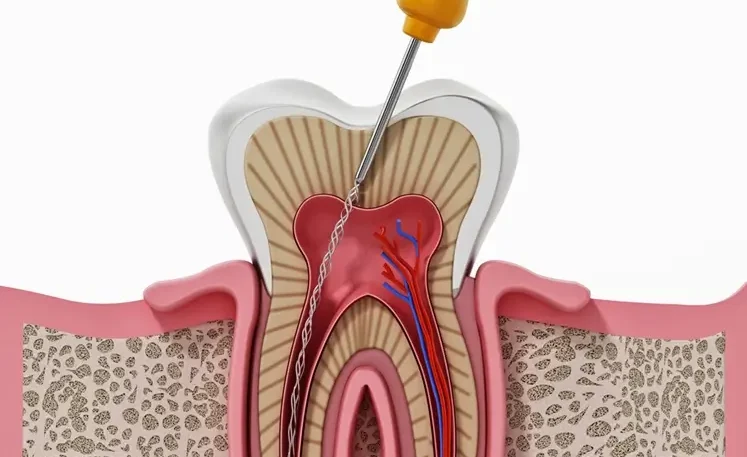 rootcanal treatment in chandanagar