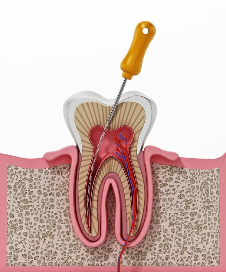 rootcanal treatment in chandanagar