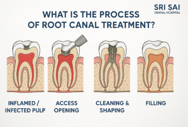 Best Root Canal Specialist in Chanda Nagar Hyderabad